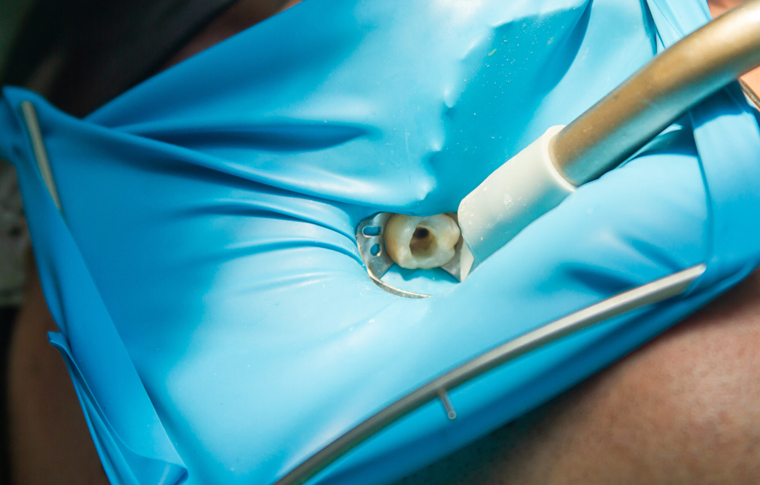 Treatment of dental canals in the upper molar permanent molar us